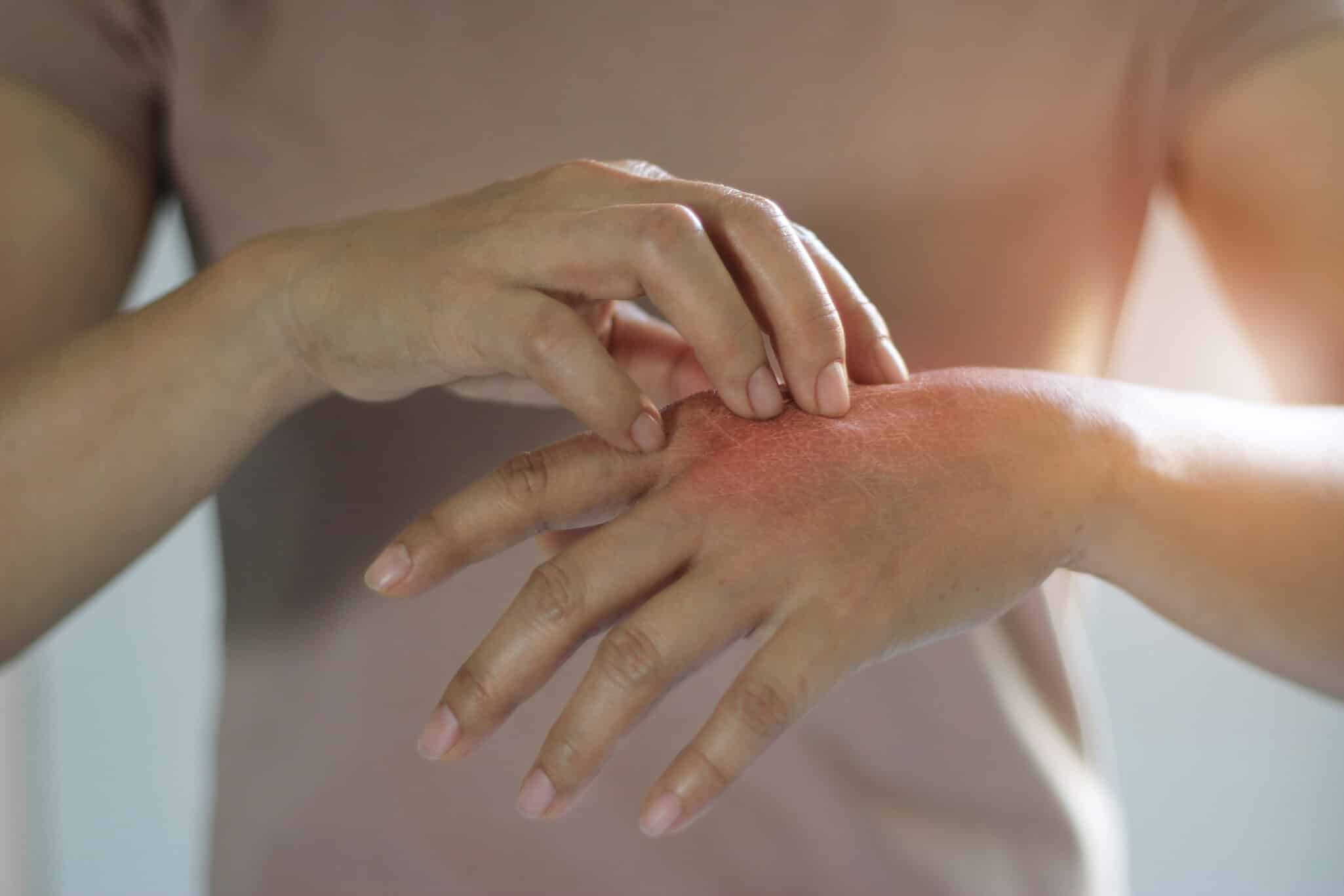Person scratching itchy hand, representing symptoms of systemic sclerosis (scleroderma), an autoimmune disease possibly influenced by genetic factors.