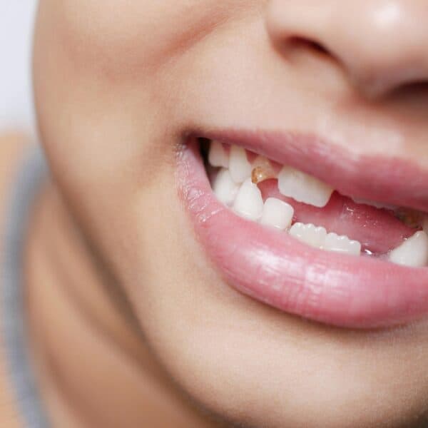 Tooth decay