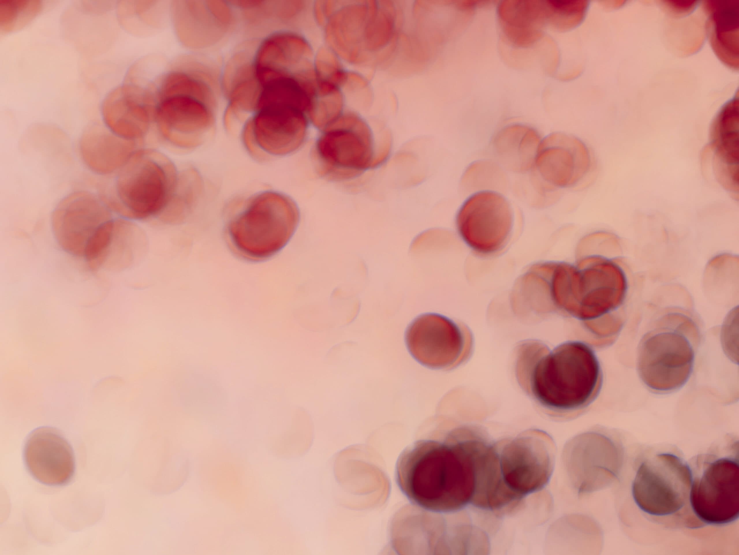 G6PD Deficiency